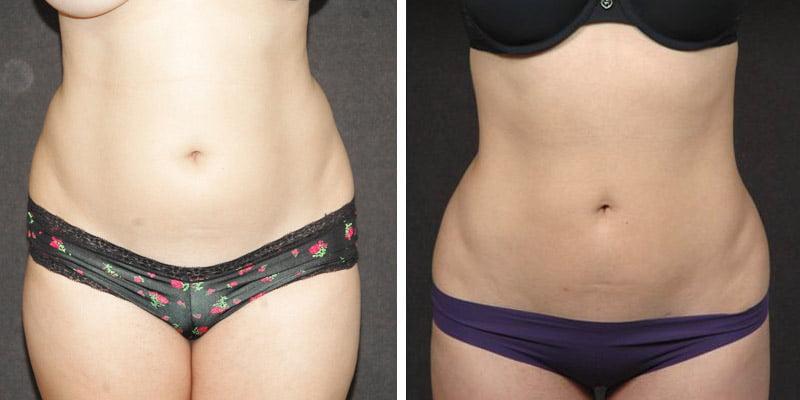 Abdominoplasty or tummy tuck : abdominal surgery in Paris