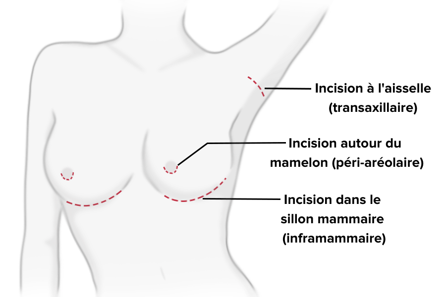 augmentation - mammaire - chirurgie - esthétique - réparatrice - allaitement