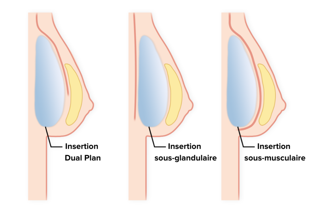 augmentation - mammaire - chirurgie - esthétique - réparatrice - allaitement