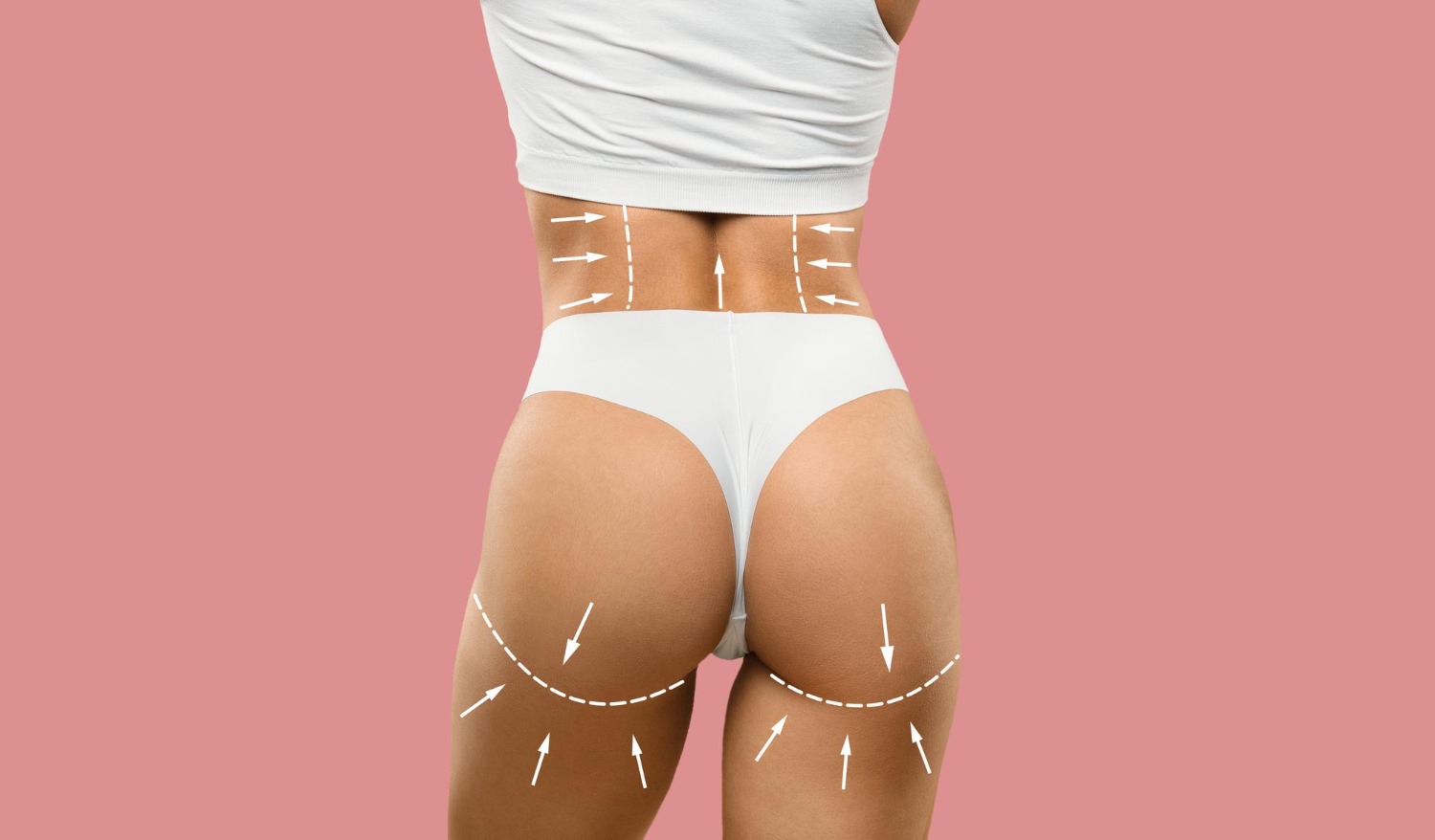 Bodylift avant après Gianfermi