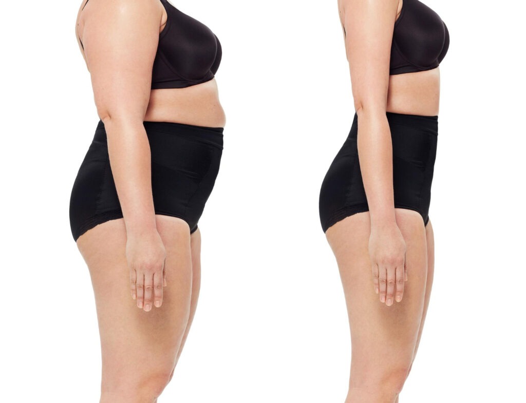 Body Lift AvantAprès, quels résultats espérer Gianfermi