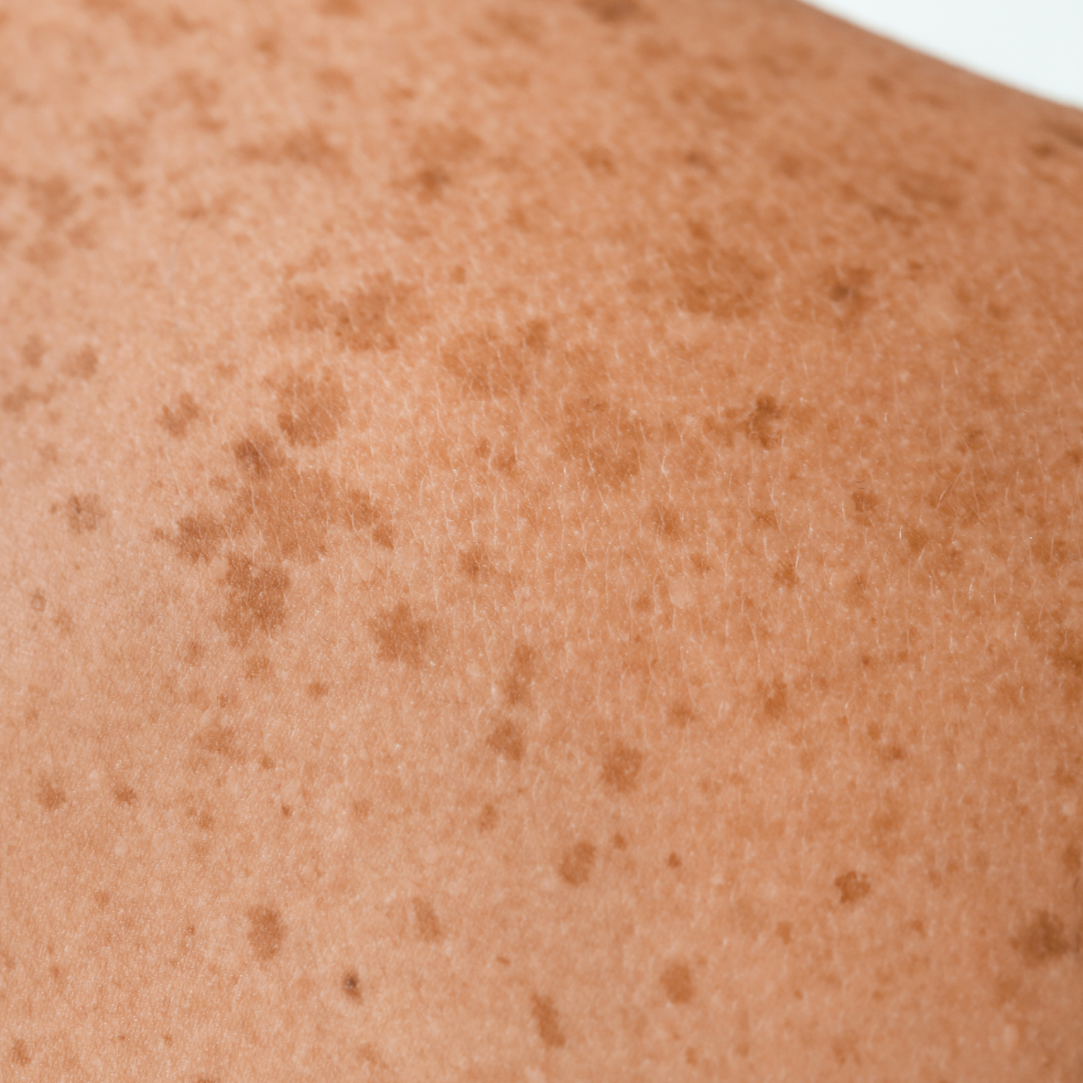 Cartographie des grains de beautés comprendre la dermatologie