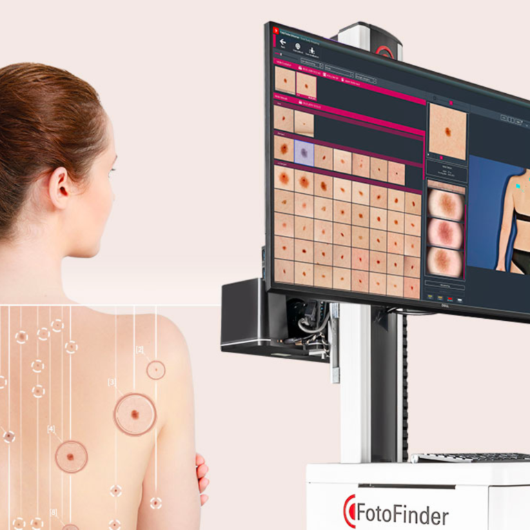 Fotofinder, prévention du cancer de la peau, détection semi-automatisée du mélanome