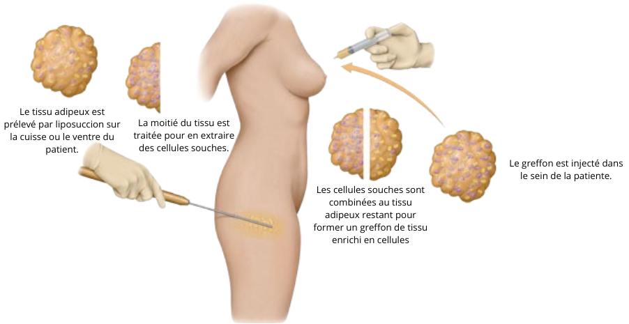 Lipofilling mammaire docteur Gianfermi Paris