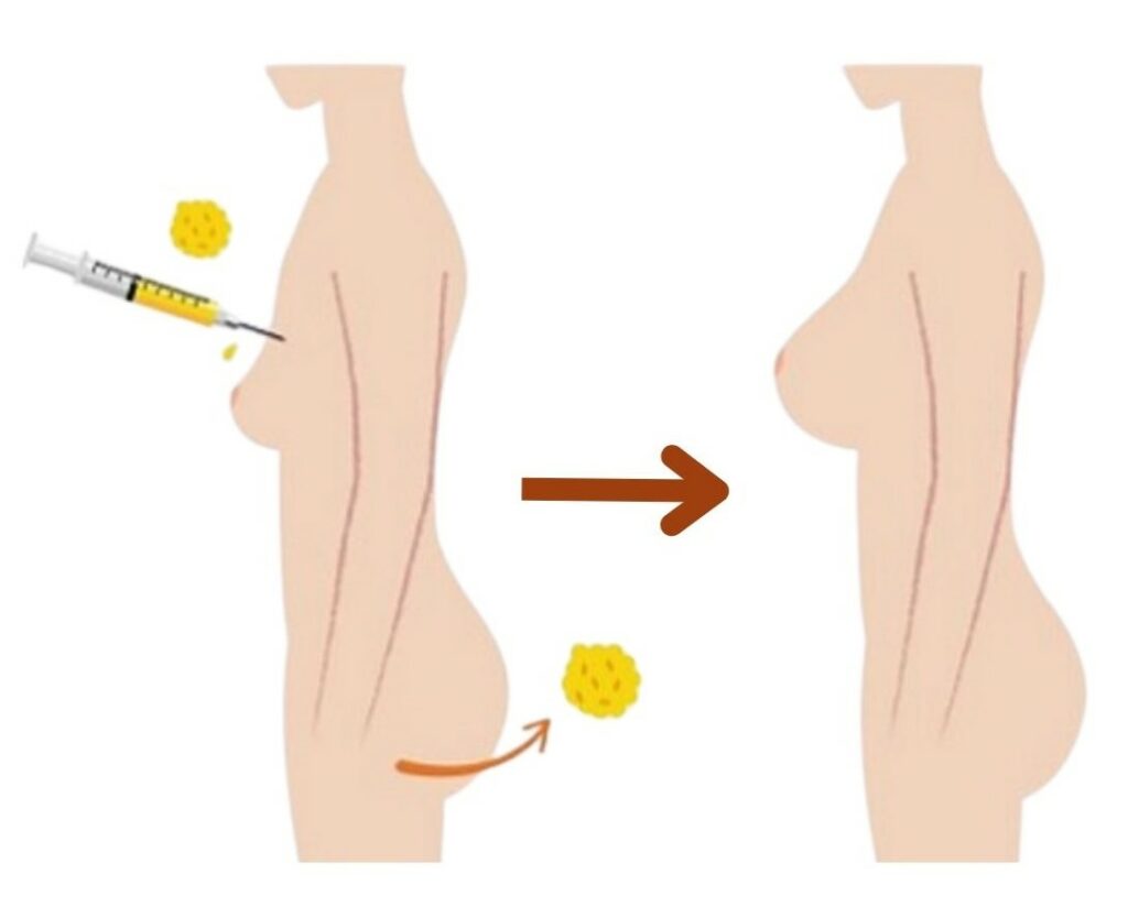 Processus de lipofilling Gianfermi