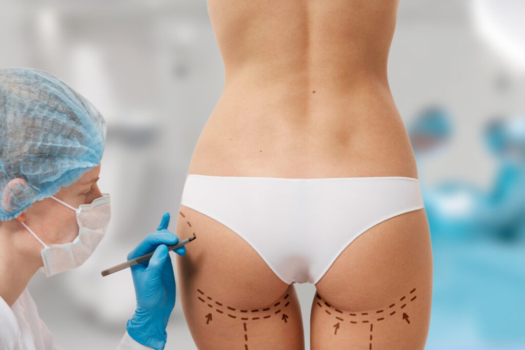 Lipofilling des fesses Gianfermi