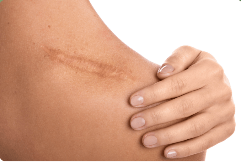 Traitements et solutions des cicatrices chéloïdes