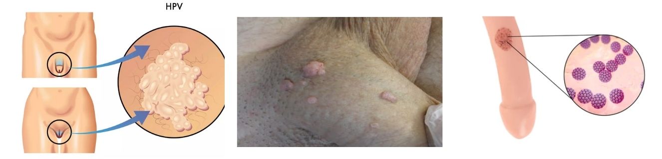 À quoi ressemble un condylome ? Aspects et signes d’alerte - Docteur ...