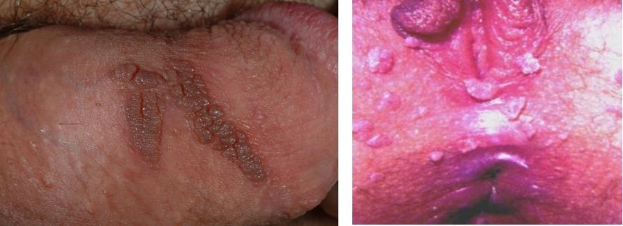 condylomes femmes Gianfermi