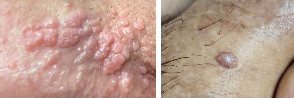 Condylome : définition, transmission et symptômes - Docteur Gianfermi