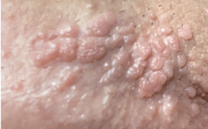 Condylomes : Définitions, informations - Docteur Gianfermi