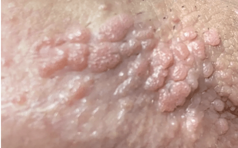 condylome symptomes gianfermi