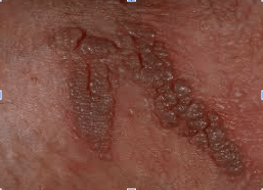 condylome feminin example