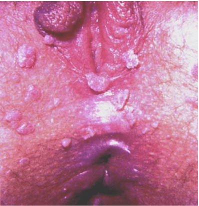 condylome feminin gianfermi
