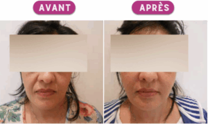 Lipofilling visage gianfermi
