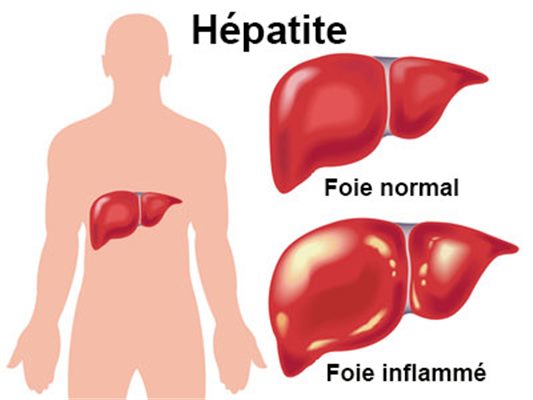 Hépatite B MST Gianfermi