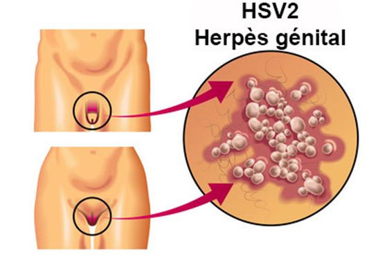 Herpes genital HSV-2 MST Gianfermi