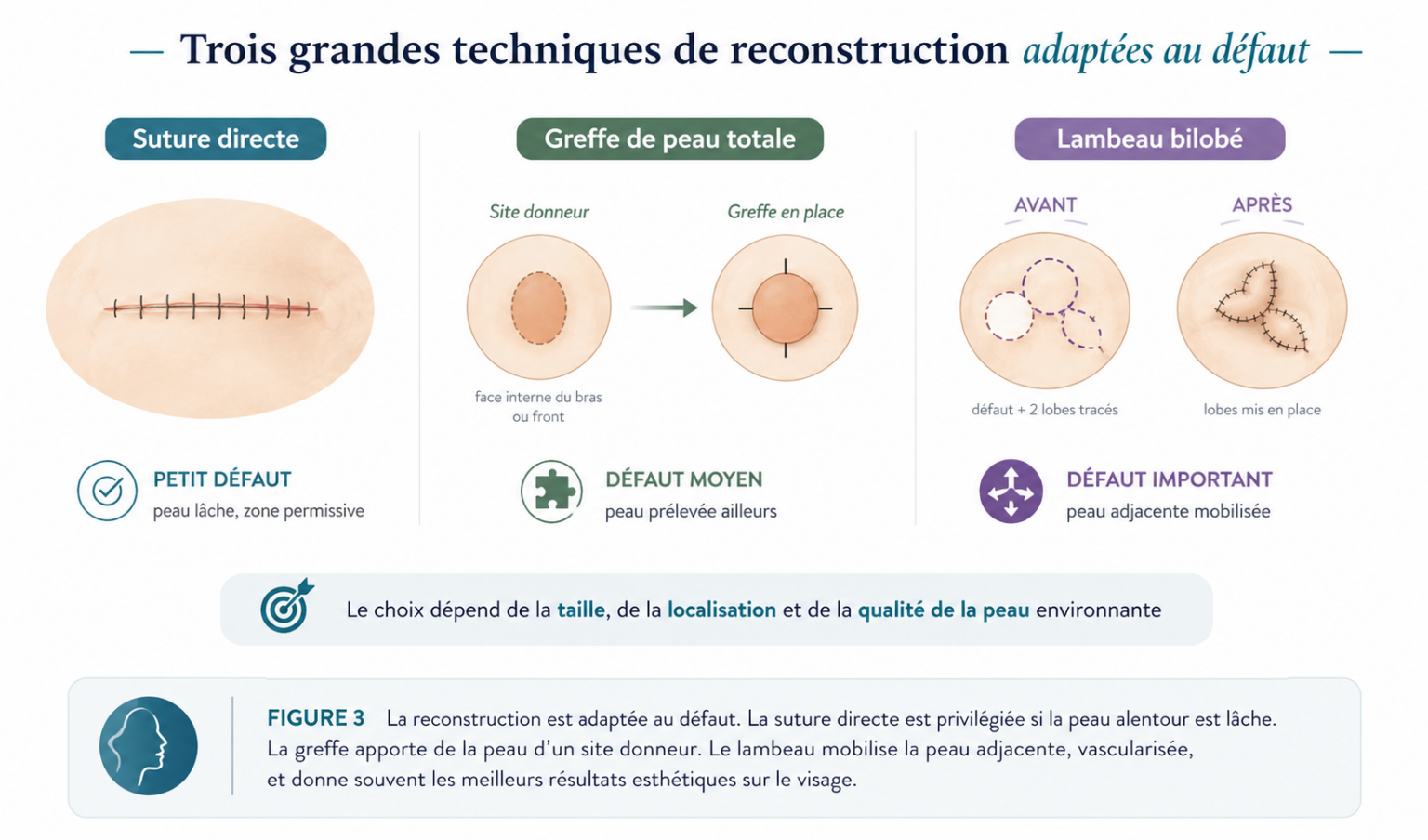 Reconstruction après chirurgie micrographique de Mohs au cabinet du Dr Gianfermi Paris
